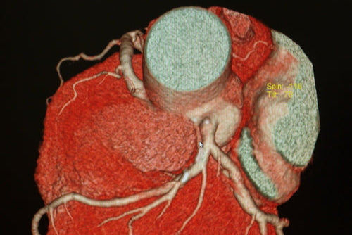 coronary angiogram