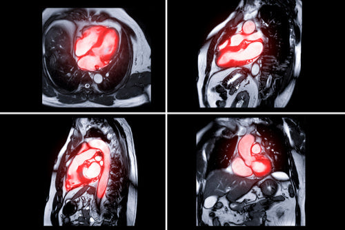 Cardiac magnetic resonance imaging (cardiac MRI)