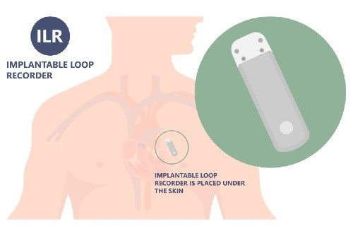 Loop Recorder Sensor Plug In Implantable Loop Recorder (ILR) - Private Treatment London – London ...